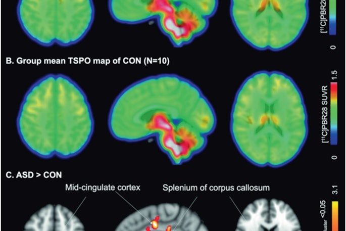 Group mean C-11 PBR28 SUVR maps of females with ASD (top) and female controls (middle). Statistical map from voxelwise comparison of C-11 PBR28 SUVR between groups, controlled for age and TSPO genotype, shows elevated regional TSPO levels relative to whole brain mean in the midcingulate cortex and splenium of the corpus callosum in ASD (N = 12) compared with controls (N = 10) (Z > 2.3, pcluster) (bottom). TSPO = translocator protein, ASD = autism spectrum disorder, CON = control, SUVR = standardized uptake value ratio, N = number. Image and caption courtesy of Neuropsychopharmacology.