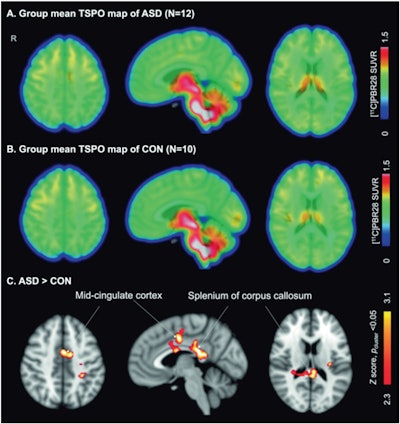 Group mean C-11 PBR28 SUVR maps of females with ASD (top) and female controls (middle). Statistical map from voxelwise comparison of C-11 PBR28 SUVR between groups, controlled for age and TSPO genotype, shows elevated regional TSPO levels relative to whole brain mean in the midcingulate cortex and splenium of the corpus callosum in ASD (N = 12) compared with controls (N = 10) (Z > 2.3, pcluster) (bottom). TSPO = translocator protein, ASD = autism spectrum disorder, CON = control, SUVR = standardized uptake value ratio, N = number. Image and caption courtesy of Neuropsychopharmacology.