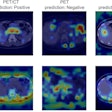Predictions and Grad-CAMs of ViT-based models on sample PET/CT, PET, and CT test images from the “positive” class. ViT was fine-tuned using training data for each modality. The bounding boxes depicted in the figure indicate malignant lesions. The top row of the Grad-CAMs shows important areas for “positive” predictions, and the bottom row shows areas for “negative” predictions. Image courtesy of Scientific Reports.