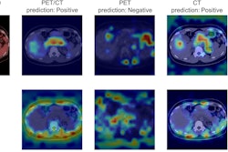 Predictions and Grad-CAMs of ViT-based models on sample PET/CT, PET, and CT test images from the “positive” class. ViT was fine-tuned using training data for each modality. The bounding boxes depicted in the figure indicate malignant lesions. The top row of the Grad-CAMs shows important areas for “positive” predictions, and the bottom row shows areas for “negative” predictions. Image courtesy of Scientific Reports.