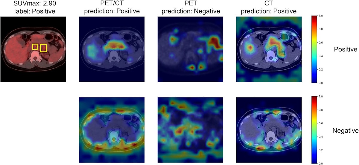 Vision transformer AI model boosts PET/CT imaging of cancer | AuntMinnie