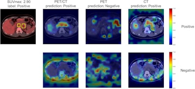 Predictions and Grad-CAMs of ViT-based models on sample PET/CT, PET, and CT test images from the “positive” class. ViT was fine-tuned using training data for each modality. The bounding boxes depicted in the figure indicate malignant lesions. The top row of the Grad-CAMs shows important areas for “positive” predictions, and the bottom row shows areas for “negative” predictions. Image courtesy of Scientific Reports.