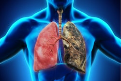 Lung Cancer