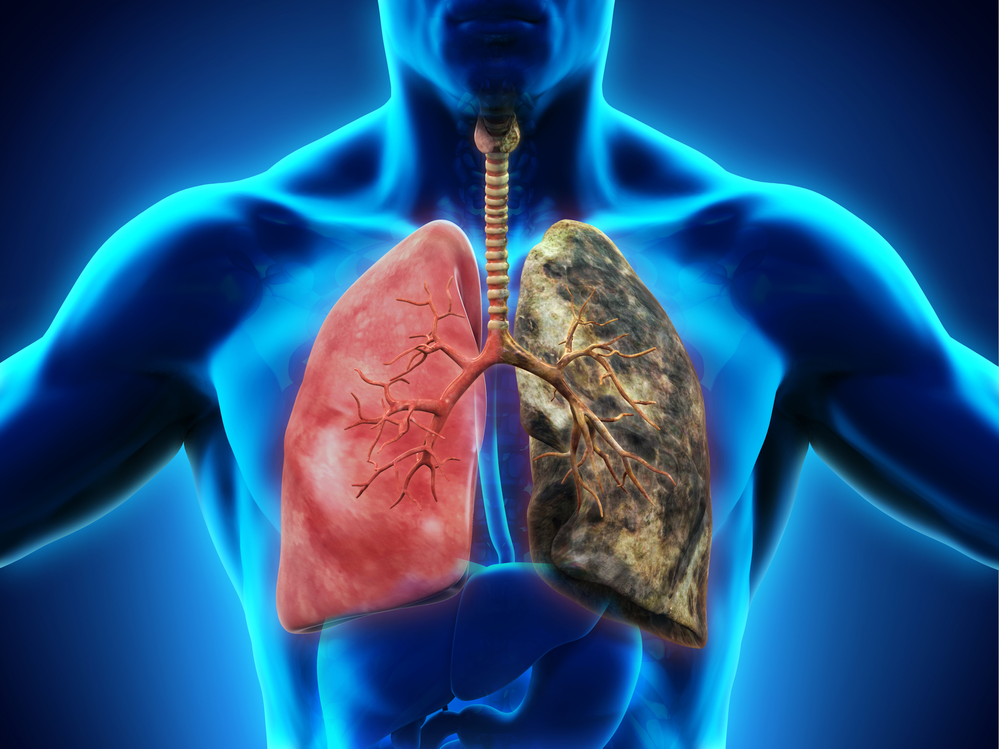 Lung Cancer