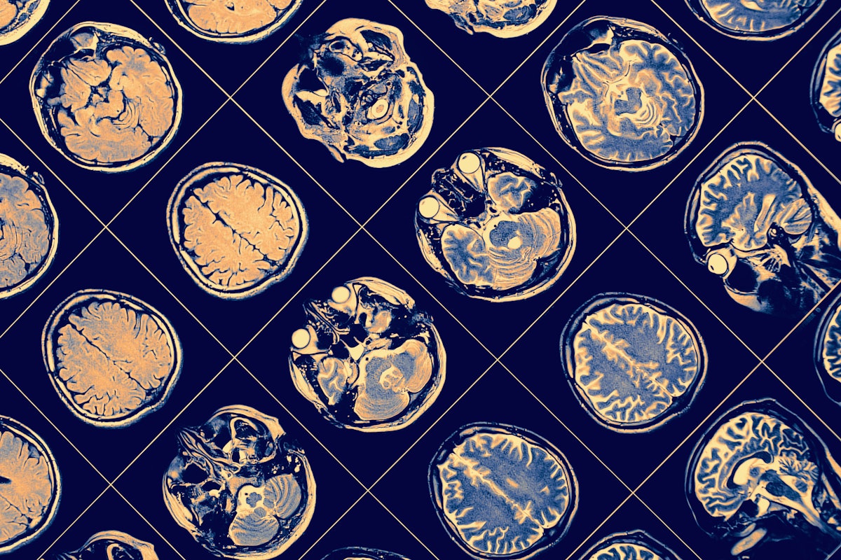 ISMRM: более высокие показатели ИМТ приводят к ухудшению здоровья мозга