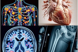 ChatGPT powered by GPT-4 and using DALL-E−3 was asked to generate an image for teaching purposes that demonstrated: a nuclear medicine bone scan with skeletal metastases (top left); coronary artery disease (top right); an F-18 FDG-PET scan of the brain with Alzheimer's disease (bottom left); and an x-ray showing a fracture (bottom right). These are misleading for educational purposes and for patients who may be searching for information. Image and caption courtesy of Radiography.