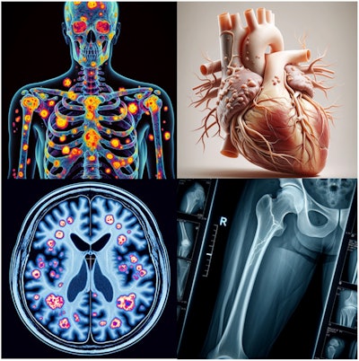 ChatGPT на базе GPT-4 и с использованием DALL-E-3 попросили создать изображение для учебных целей, демонстрирующее: сканирование костей с помощью ядерной медицины со скелетными метастазами (вверху слева); ишемическая болезнь сердца (вверху справа); ПЭТ-сканирование F-18 ФДГ головного мозга при болезни Альцгеймера (внизу слева); и рентгеновский снимок, показывающий перелом (внизу справа). Они вводят в заблуждение в образовательных целях и для пациентов, которые могут искать информацию. Изображение и подпись любезно предоставлены Radioography.