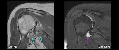 Coronal MR images of a 66-year-old woman show definite small AIGM (blue arrows), corresponding to diagnostic confidence of 4. There is also high-grade glenohumeral osteoarthrosis, as well as small joint effusion (purple arrow).