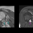 2024 05 06 Arrs Shoulder Mri Thumbnail