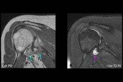 2024 05 06 Arrs Shoulder Mri Thumbnail