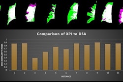 Dice similarity index measurements compare the x-ray pulsatility index (XPI) to digital subtraction angiography in patients with suspected chronic thromboembolic pulmonary hypertension. XPI is green, pulmonary angiography is pink and the overlap between the two is white. Image courtesy of the ARRS.