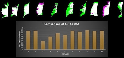 Dice similarity index measurements compare the x-ray pulsatility index (XPI) to digital subtraction angiography in patients with suspected chronic thromboembolic pulmonary hypertension. XPI is green, pulmonary angiography is pink and the overlap between the two is white. Image courtesy of the ARRS.