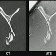 Sagittal view of the scapula showing a comminuted fracture of the inferior portion, imaged with computed tomography (CT, left image) and by an ultrashort time of echo (UTE) sequence (right image) on MRI. Both images appear similar, with an identical representation of the fracture, illustrating the potential of UTE to create CT-like images and suggesting that both imaging modalities could be interchangeable in clinical practice. All images and captions courtesy of Prof. Benjamin Fritz, MD.