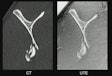 Sagittal view of the scapula showing a comminuted fracture of the inferior portion, imaged with computed tomography (CT, left image) and by an ultrashort time of echo (UTE) sequence (right image) on MRI. Both images appear similar, with an identical representation of the fracture, illustrating the potential of UTE to create CT-like images and suggesting that both imaging modalities could be interchangeable in clinical practice. All images and captions courtesy of Prof. Benjamin Fritz, MD.