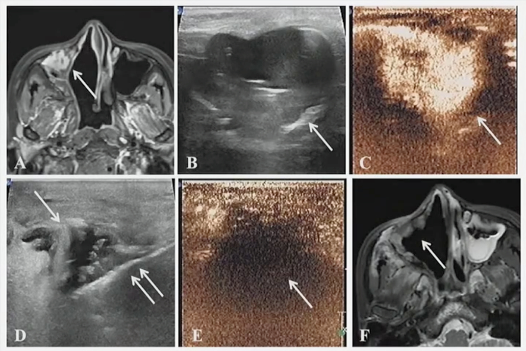 A case presented at the ARRS annual meeting shows the results of successful microwave ablation (MWA) treatment for a 39-year-old female with metastatic fibrosarcoma of the right axillary sinus.