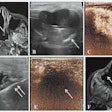 A case presented at the ARRS annual meeting shows the results of successful microwave ablation (MWA) treatment for a 39-year-old female with metastatic fibrosarcoma of the right axillary sinus.