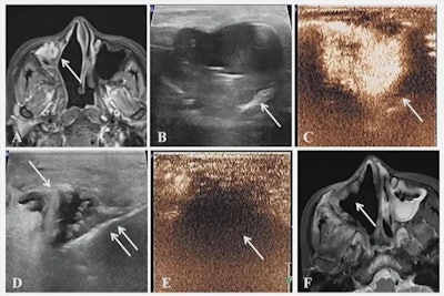 A case presented at the ARRS annual meeting shows the results of successful microwave ablation (MWA) treatment for a 39-year-old female with metastatic fibrosarcoma of the right axillary sinus.