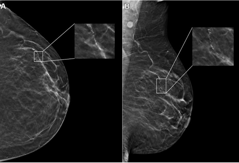 An example mammogram was assigned a false-positive case score of 96 in a 59-year-old Black patient with scattered fibroglandular breast density by an FDA-approved AI algorithm. (A) Left craniocaudal and (B) mediolateral oblique views demonstrate vascular calcifications in the upper outer quadrant at middle depth (box) that were singularly identified by the algorithm as a suspicious finding and assigned an individual lesion score of 90. This resulted in an overall case score assigned to the mammogram of 96.