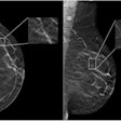 An example mammogram was assigned a false-positive case score of 96 in a 59-year-old Black patient with scattered fibroglandular breast density by an FDA-approved AI algorithm. (A) Left craniocaudal and (B) mediolateral oblique views demonstrate vascular calcifications in the upper outer quadrant at middle depth (box) that were singularly identified by the algorithm as a suspicious finding and assigned an individual lesion score of 90. This resulted in an overall case score assigned to the mammogram of 96.