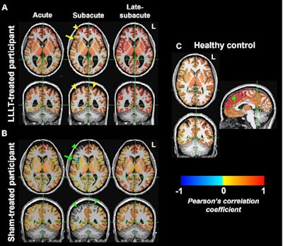 Functional MRI brain maps of resting-state functional connectivity in representative age- and sex-matched participants. (A, B) Axial (top) and coronal (bottom) views show whole-brain connectivity, with the seed at the left (L) superior frontal region, in a 36-year-old female participant in the low-level light therapy (LLLT) treatment group (A) and a 38-year-old female participant in the sham treatment group (B) during the acute, subacute, and late-subacute phases (columns, from left to right, in both A and B) of traumatic brain injury recovery. (C) Axial (top left), coronal (bottom left), and sagittal (right) views in a 38-year-old female control participant are shown for comparison; the solid green circle in the sagittal view indicates the location of the left superior frontal seed region. The color bar indicates that brain regions with warm colors (red, orange, yellow) show resting-state fluctuations that have significant positive correlation (r of 0 to 1) with those of the left superior frontal region, and brain regions with cold colors (blue) show resting-state fluctuations that have significant negative correlation (r of −1 to 0) with those of the left superior frontal region. Brain regions that have functional connectivity with the left superior frontal seed in the LLLT-treated participant (arrowheads in A) but not in the sham-treated participant (arrowheads in B) are shown. The arrow in A additionally shows brain regions with positive correlation with the seed in the LLLT-treated participant, but negative correlation with the seed in the sham-treated participant (arrow in B). All connections shown here achieved a false discovery rate–adjusted p < 0.005. Images and caption courtesy of the RSNA.