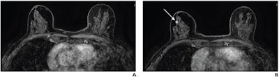 (A) Axial subtracted contrast-enhanced fat-suppressed T1-weighted image from a baseline abbreviated MRI examination is negative (BI-RADS category 1). (B) Axial subtracted contrast-enhanced fat-suppressed T1-weighted image from a subsequent-round abbreviated MRI examination performed two years later shows a new 5-mm enhancing mass in the upper outer right breast (arrow), which was not seen on a mammogram performed five months prior. The exam was assessed as BI-RADS category 5. Ultrasound-guided core biopsy yielded invasive ductal carcinoma (ER+/PR+/HER2-). Image courtesy of the ARRS.