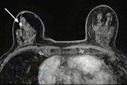 topics for research in ultrasound 70 Year Old Woman With Extremely Dense Breasts Thumbnail
