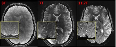 Caption: T2*-weighted 2D GRE acquisitions at 3T, 7T, and 11.7T (different volunteers). Sequence parameters : FA = 27°, TR = 600 ms, TE = 20 ms, resolution = 0.2 × 0.2 × 1 mm3, GRAPPA = 2, bandwidth = 40 Hz/px, TA = 4 min 20 s. Acquisitions were performed with 1 (body coil) Tx-32Rx, 8Tx-32Rx, and 8Tx-32Rx head coils at 3T, 7T, and 11.7T respectively.