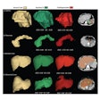 This image shows ground-truth manual organ segmentations (yellow) vs. DynUNet-TL (green) and TotalSegmentator (red) predictions. Photo courtesy of the American Journal of Roentgenology.