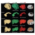 This image shows ground-truth manual organ segmentations (yellow) vs. DynUNet-TL (green) and TotalSegmentator (red) predictions. Photo courtesy of the American Journal of Roentgenology.