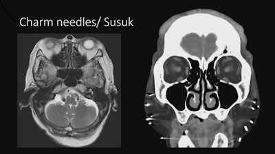 Imaging showing implanted charm needles in a patient.
