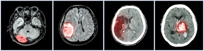Mri Brain Disease Montage
