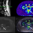 A 47-year-old female patient with chronic pain in the left lower back/buttock with unknown cause. PET demonstrated focally increased FDG uptake at the left facet L3-4 l. MRI shows minimal fluid, but no edema. Follow-up PET-MRI after six months shows a similar pattern. The patient is on the waiting list for targeted facet joint infiltration (typically not covered by insurance in the Netherlands).