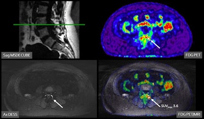 A 47-year-old female patient with chronic pain in the left lower back/buttock with unknown cause. PET demonstrated focally increased FDG uptake at the left facet L3-4 l. MRI shows minimal fluid, but no edema. Follow-up PET-MRI after six months shows a similar pattern. The patient is on the waiting list for targeted facet joint infiltration (typically not covered by insurance in the Netherlands).