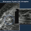 topics for research in ultrasound Images of a 39-year-old woman shows a grade 2 invasive ductal carcinoma on mammography, confirmed by supplementary ultrasound. Mammography detected an asymmetry with calcifications while ultrasound examination revealed a hyperechoic mass. The resulting sentinel lymph node biopsy was negative.