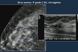Images of a 39-year-old woman shows a grade 2 invasive ductal carcinoma on mammography, confirmed by supplementary ultrasound. Mammography detected an asymmetry with calcifications while ultrasound examination revealed a hyperechoic mass. The resulting sentinel lymph node biopsy was negative.