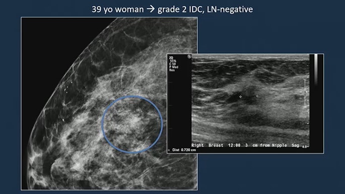 Images of a 39-year-old woman shows a grade 2 invasive ductal carcinoma on mammography, confirmed by supplementary ultrasound. Mammography detected an asymmetry with calcifications while ultrasound examination revealed a hyperechoic mass. The resulting sentinel lymph node biopsy was negative.