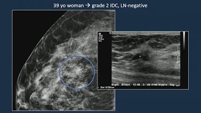 Images of a 39-year-old woman shows a grade 2 invasive ductal carcinoma on mammography, confirmed by supplementary ultrasound. Mammography detected an asymmetry with calcifications while ultrasound examination revealed a hyperechoic mass. The resulting sentinel lymph node biopsy was negative.