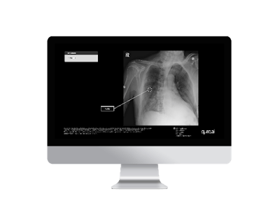 Qure.ai will unveil its lung care continuum at the ASCO annual meeting.