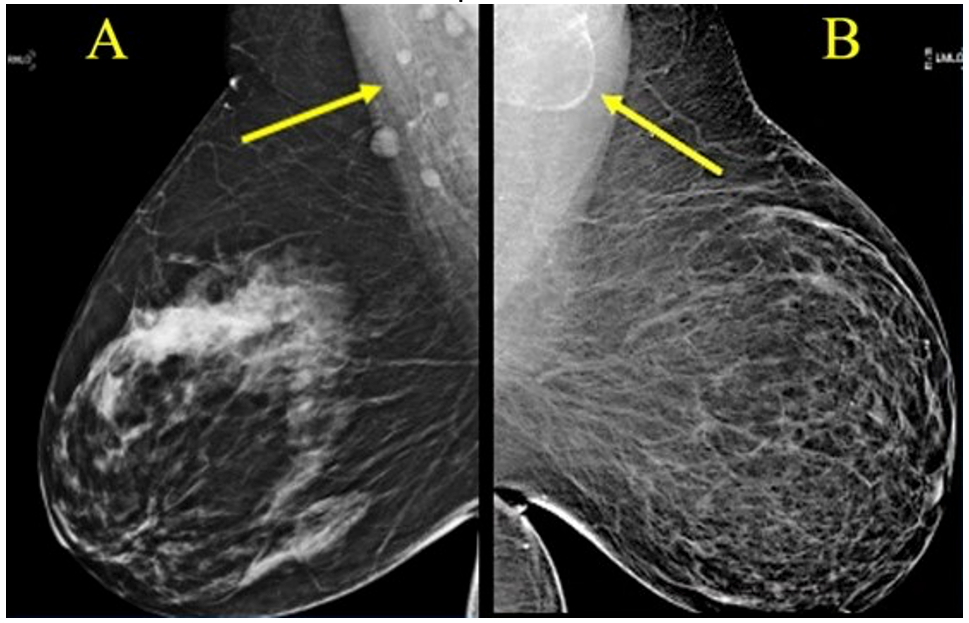 Award-winning research: Screening mammograms showed variable lymph node morphology due to ectopic fat deposition in women with obesity. Image A (above) shows normal axillary lymph nodes measuring < 1.5 cm in 63-year-old woman with a body mass index (BM) = 43.2. Image B shows a possible fat-enlarged axillary node with large fatty hilum measuring 4.2 cm in a 52-year-old woman with a BMI = 45.8. Photo courtesy of American Roentgen Ray Society.