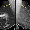 Award-winning research: Screening mammograms showed variable lymph node morphology due to ectopic fat deposition in women with obesity. Image A (above) shows normal axillary lymph nodes measuring < 1.5 cm in 63-year-old woman with a body mass index (BM) = 43.2. Image B shows a possible fat-enlarged axillary node with large fatty hilum measuring 4.2 cm in a 52-year-old woman with a BMI = 45.8. Photo courtesy of American Roentgen Ray Society.
