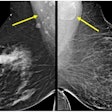 Award-winning research: Screening mammograms showed variable lymph node morphology due to ectopic fat deposition in women with obesity. Image A (above) shows normal axillary lymph nodes measuring < 1.5 cm in 63-year-old woman with a body mass index (BM) = 43.2. Image B shows a possible fat-enlarged axillary node with large fatty hilum measuring 4.2 cm in a 52-year-old woman with a BMI = 45.8. Photo courtesy of American Roentgen Ray Society.