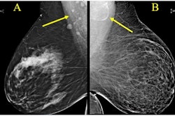 Award-winning research: Screening mammograms showed variable lymph node morphology due to ectopic fat deposition in women with obesity. Image A (above) shows normal axillary lymph nodes measuring < 1.5 cm in 63-year-old woman with a body mass index (BM) = 43.2. Image B shows a possible fat-enlarged axillary node with large fatty hilum measuring 4.2 cm in a 52-year-old woman with a BMI = 45.8. Photo courtesy of American Roentgen Ray Society.