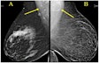 Award-winning research: Screening mammograms showed variable lymph node morphology due to ectopic fat deposition in women with obesity. Image A (above) shows normal axillary lymph nodes measuring < 1.5 cm in 63-year-old woman with a body mass index (BM) = 43.2. Image B shows a possible fat-enlarged axillary node with large fatty hilum measuring 4.2 cm in a 52-year-old woman with a BMI = 45.8. Photo courtesy of American Roentgen Ray Society.
