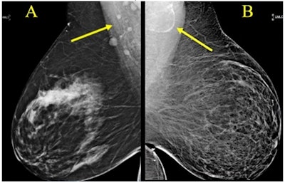 Award-winning research: Screening mammograms showed variable lymph node morphology due to ectopic fat deposition in women with obesity. Image A (above) shows normal axillary lymph nodes measuring < 1.5 cm in 63-year-old woman with a body mass index (BM) = 43.2. Image B shows a possible fat-enlarged axillary node with large fatty hilum measuring 4.2 cm in a 52-year-old woman with a BMI = 45.8. Photo courtesy of American Roentgen Ray Society.
