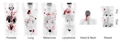 Illustrative examples of the predicted tumor segmentations by the deep transfer learning approach across six cancer types. Pretherapy and post-therapy scans are shown for breast cancer. Image and caption courtesy of SNMMI.