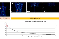 Lesion uptake from a patient with a solitary fibrous tumor and its FAP expression on gallium-68 (GA-68)-FAPI-46 (A) and intratherpeutic Y-90-FAPI-46 (B). The panel shows the constructed time activity curve with the three PET/CT measurements.