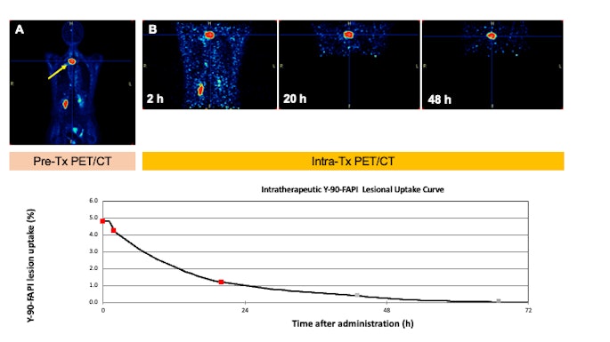 Lesion uptake from a patient with a solitary fibrous tumor and its FAP expression on gallium-68 (GA-68)-FAPI-46 (A) and intratherpeutic Y-90-FAPI-46 (B). The panel shows the constructed time activity curve with the three PET/CT measurements.