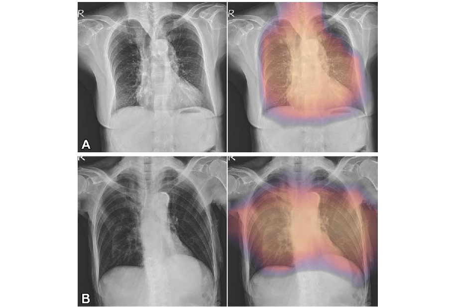 2024 06 25 Radiology Ai Osteoporosis Screening Chest X Rays Lin Image