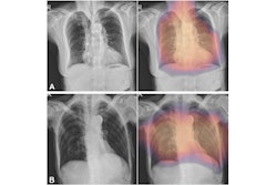 2024 06 25 Radiology Ai Osteoporosis Screening Chest X Rays Lin Image