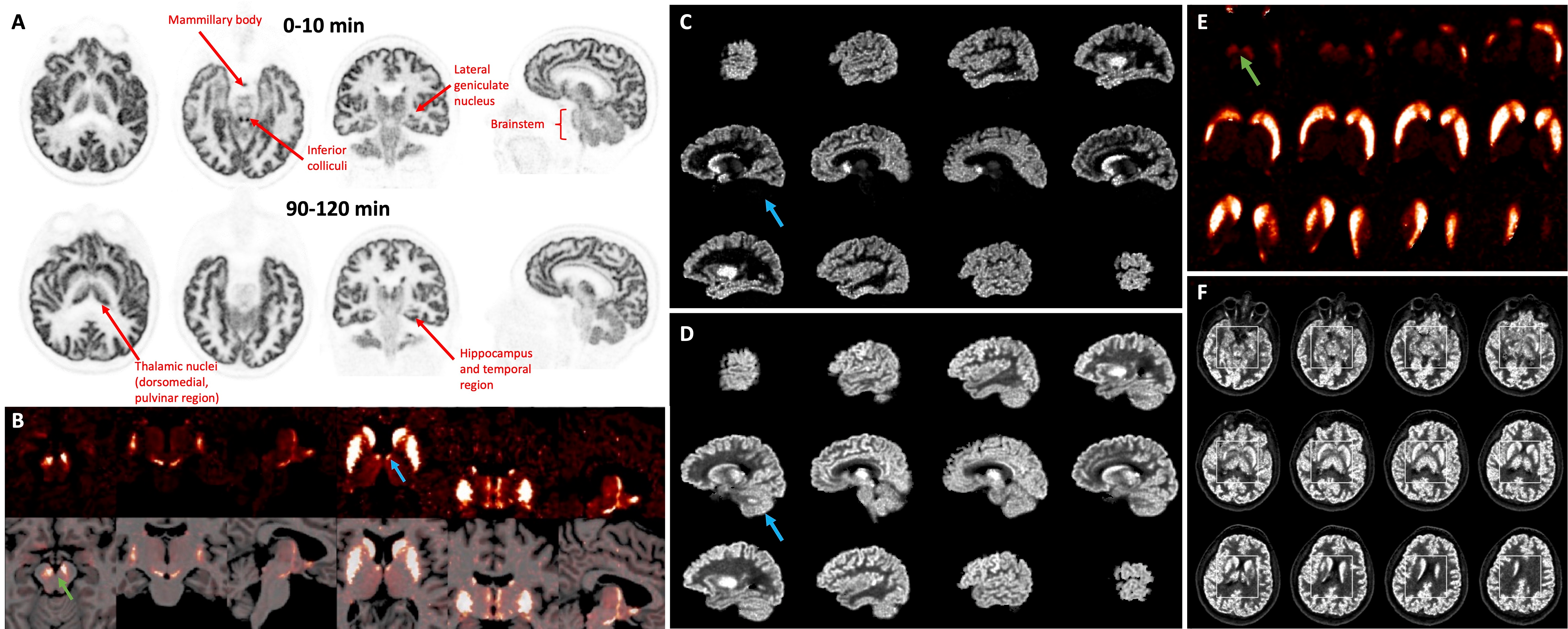 F-18 SynVesT-1 images at early (0-10) and late (90-120 minute) times postinjection. There is clear identification of high flow regions in the early images. The late images show the synaptic (SV2A) pattern which differs from the flow pattern, e.g., in the thalamus. B. 11C-PHNO binding potential (BPND) images shown in transverse, coronal, and sagittal orientations of PET alone and PET overlaid with MRI. Left: Region of substantia nigra (green arrow, max display: 4.0). Right: Thalamic region (max: 2.5) showing focal bilateral binding in a specific thalamic nucleus (blue arrow, likely anteroventral nucleus). C. Sagittal images of 11C-LSN3172176 M1 muscarinic cholinergic BPND (max display: 10). D. R1 images of the same tracer (max: 2). Cerebellum (blue arrow) shows no specific binding (C) and high tracer delivery (D). E. 18F-FE-PE2I dopamine transporter BPND images (zoomed, max display: 6) showing striatum and substantia nigra (green arrow). F. R1 images of the same tracer (max: 2) with inset showing zoomed region in E.